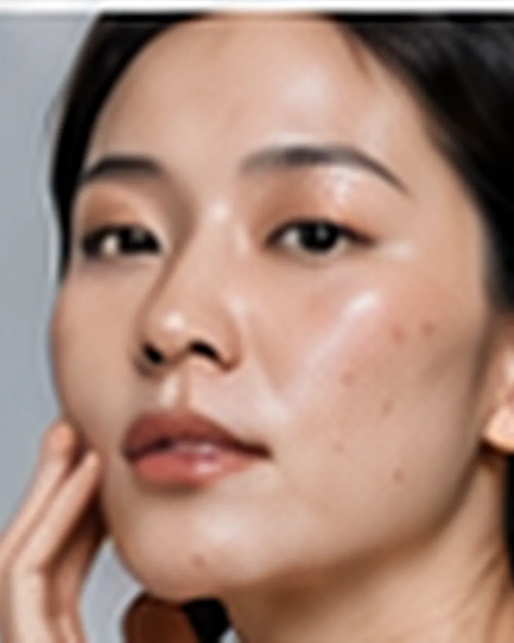 Acne & Scarring